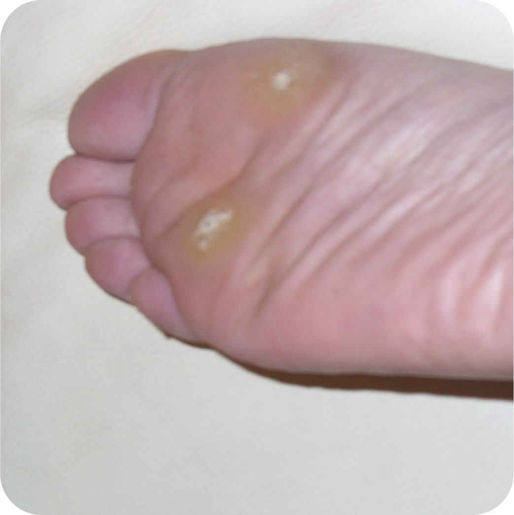 Foot Warts